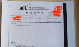 38岁，喜提管状腺瘤一枚